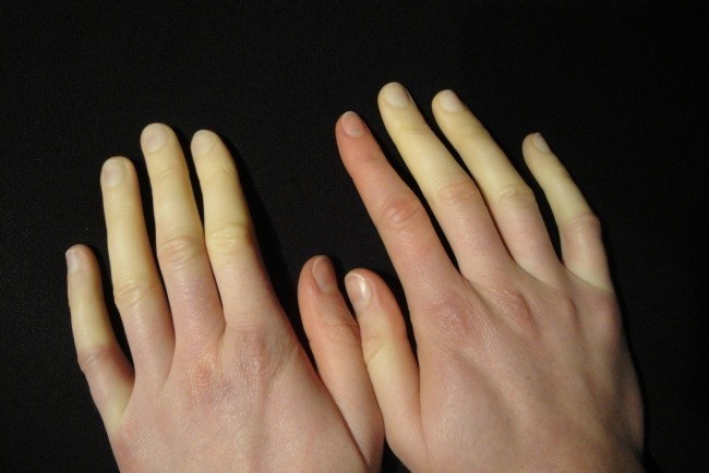 Οι αλλαγές χρώματος στα δάχτυλά σας